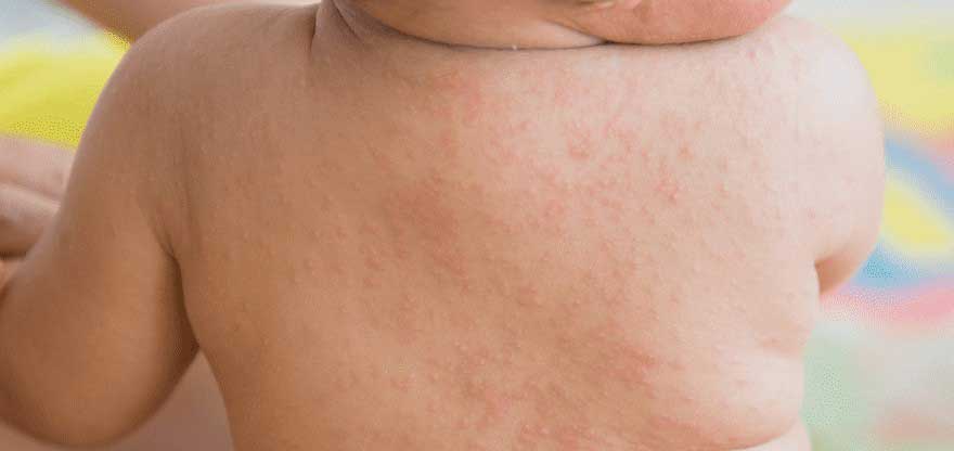 Symptoms of actinic Roseola Infantum - Dr Yeung Ho Hong 楊浩康