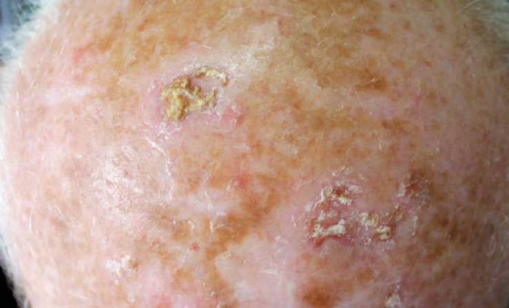 Symptoms of actinic keratosis - Yeung Ho Hong 楊浩康